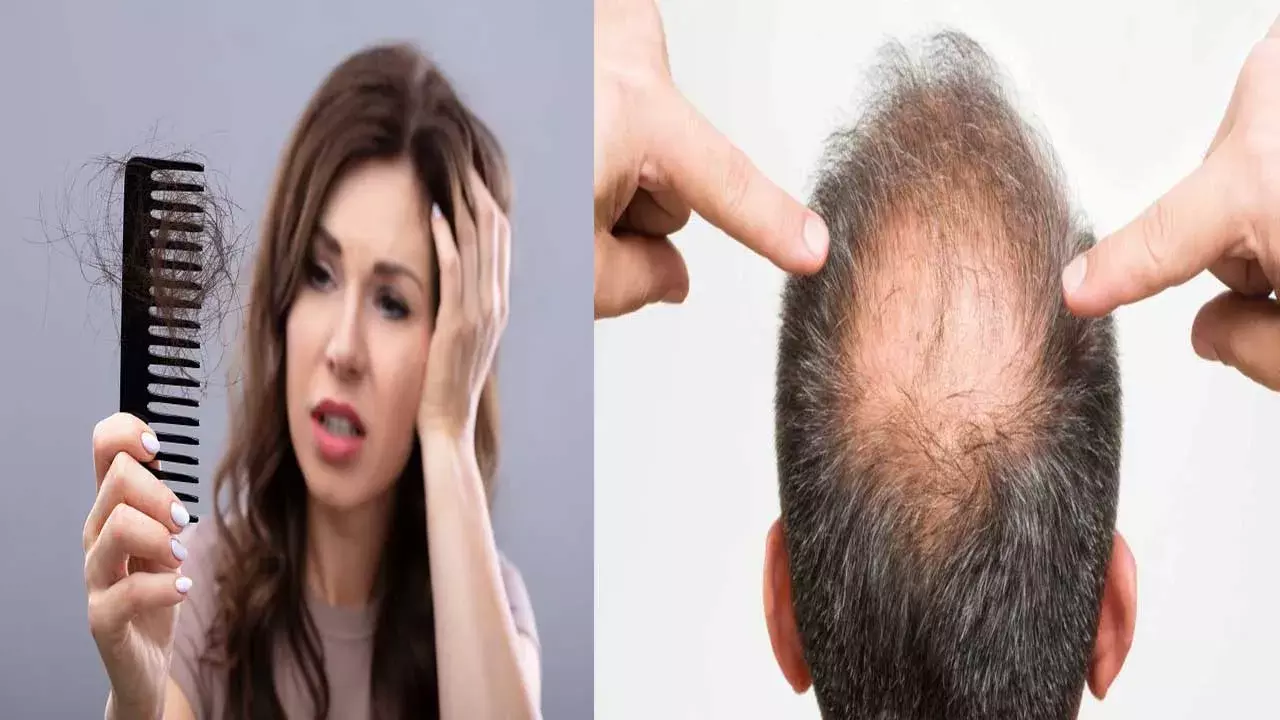 Hair Loss : ఈ తప్పులు చేస్తే బట్టతల రావడం ఖాయం