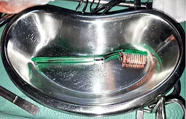 Toothbrush in intestine: టూత్‌బ్రష్‌ను మింగేసిన మహిళ!