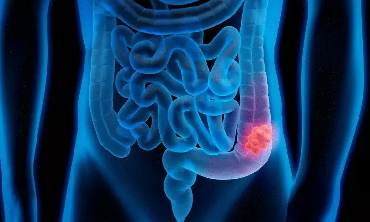 రోజువారీ ఆహారంలో తగినంత ఫైబర్‌ లేకపోతే పేగు క్యాన్సర్..  పరిశోధనలు వెల్లడి..