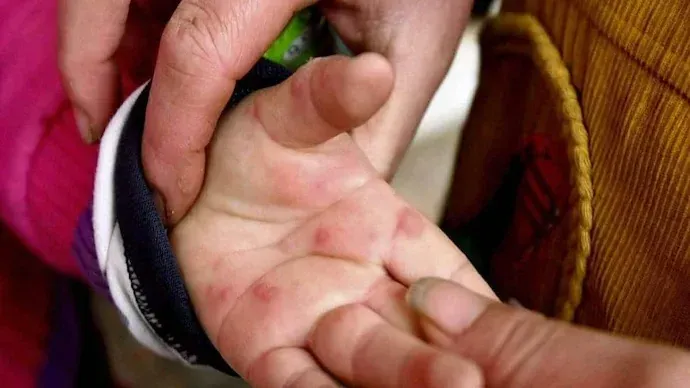 Tomato virus : మధ్యప్రదేశ్లో టమాటా వైరస్ కలకలం. Tomato virus : మధ్యప్రదేశ్లో టమాటా వైరస్ కలకలం.