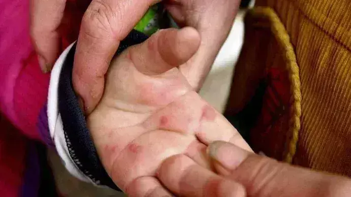 Tomato virus : మధ్యప్రదేశ్‌లో  టమాటా వైరస్ కలకలం.