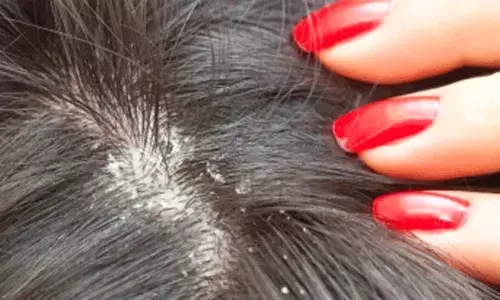 శీతాకాలంలో శిరోజాల సంరక్షణ.. 4 సహజ నివారణ పద్దతులు..