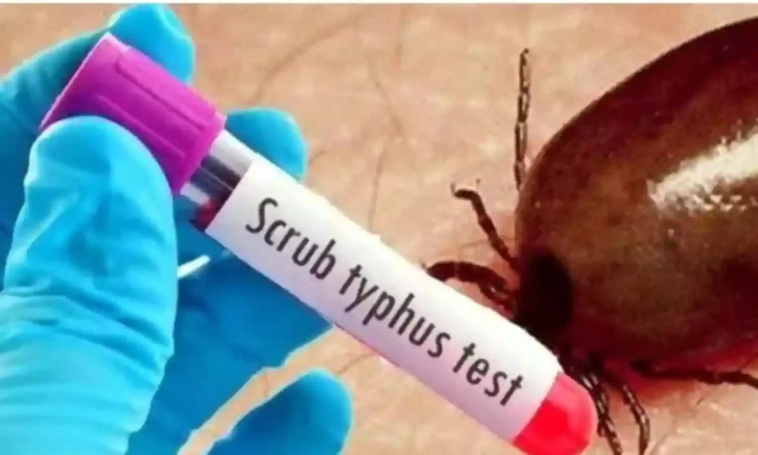 AP: ఏపీని వణికిస్తున్న స్క్రబ్ టైఫస్ కేసులు AP: ఏపీని వణికిస్తున్న స్క్రబ్ టైఫస్ కేసులు