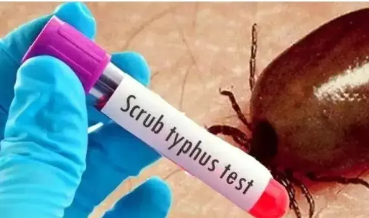 AP: ఏపీని వణికిస్తున్న స్క్రబ్ టైఫస్ కేసులు