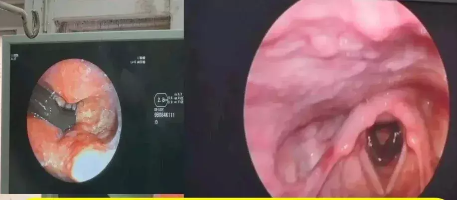 Leech Stuck In Throat  : వ్యక్తి గొంతులో ఇరుక్కుపోయిన జలగ..డాక్టర్లు ఏం చేశారంటే ?